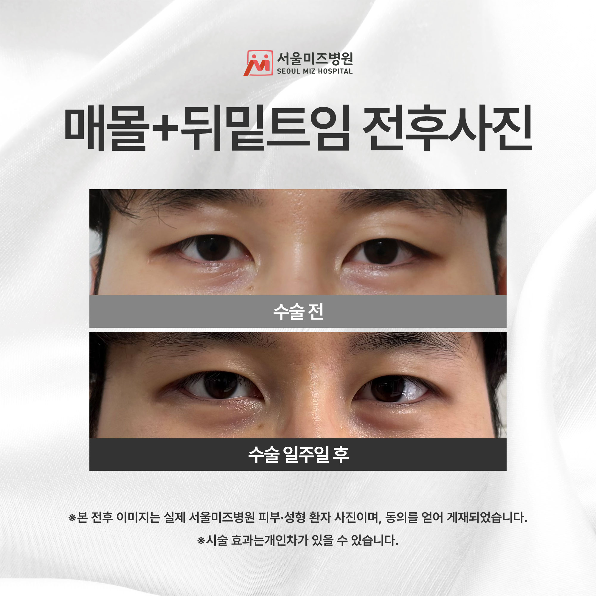 매몰+뒤밑트임 전후사진