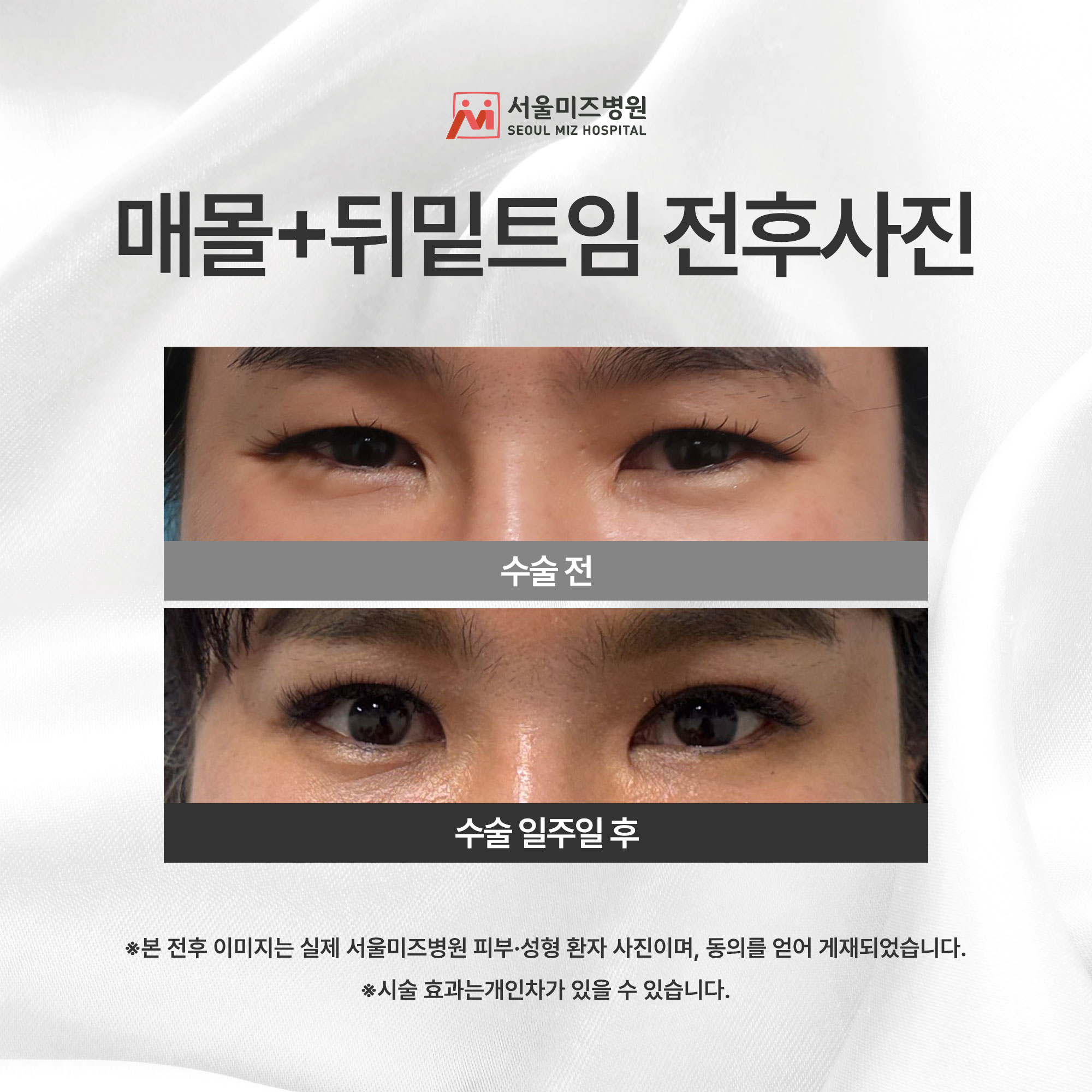 매몰+뒤밑트임 전후사진