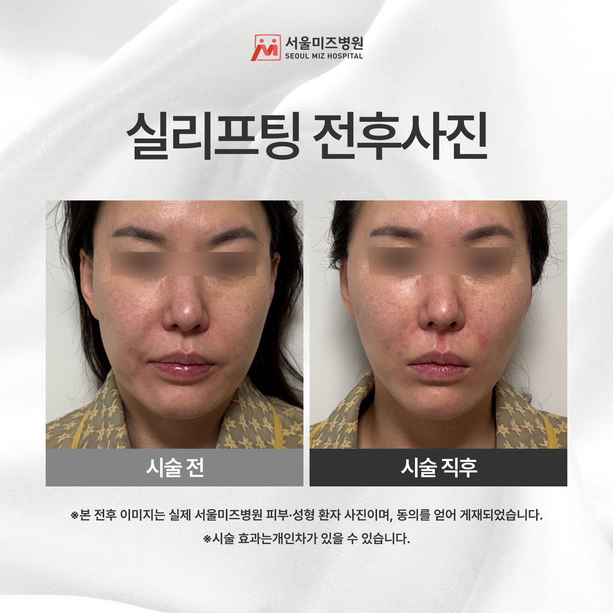 실리프팅 전후사진