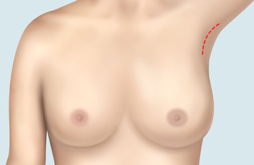 겨드랑이 절개법