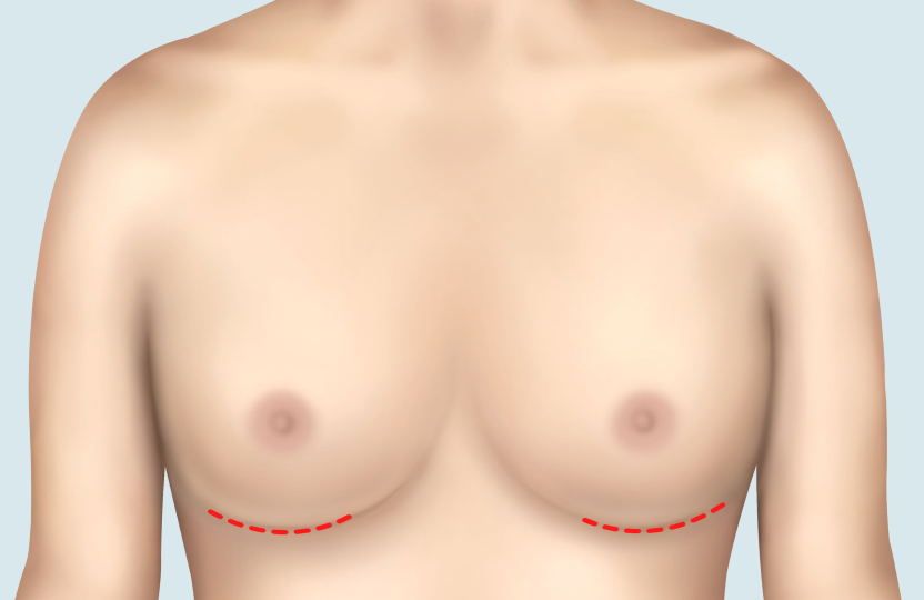가슴밑선 절개법