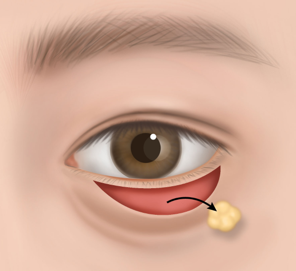 재배치 후 봉합